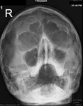 фото Рентгенография околоносовых пазух (1 проекция)