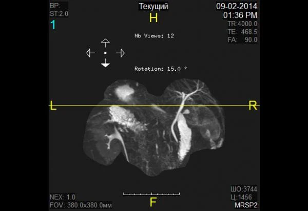 Фото МР-холецистопанкреатохолангиография