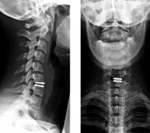 фото Рентгенография шейного отдела позвоночника с функциональными пробами (2 снимка)
