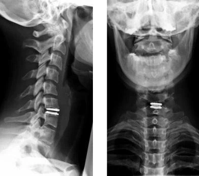 Фото Рентгенография шейного отдела позвоночника с функциональными пробами (2 снимка)