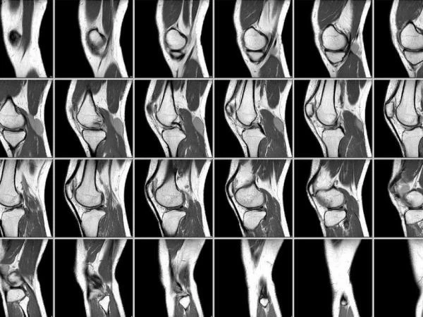Фото МРТ коленного сустава