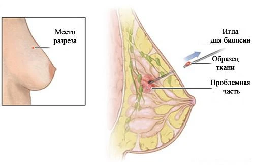 Фото Трепан–биопсия молочной железы