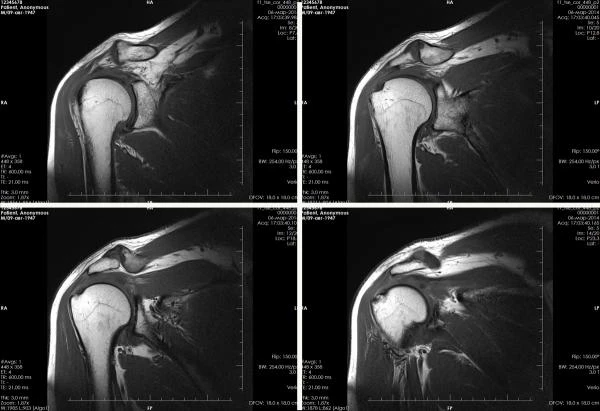 Фото МРТ плечевого сустава