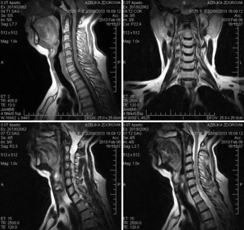 Фото МРТ шейного
