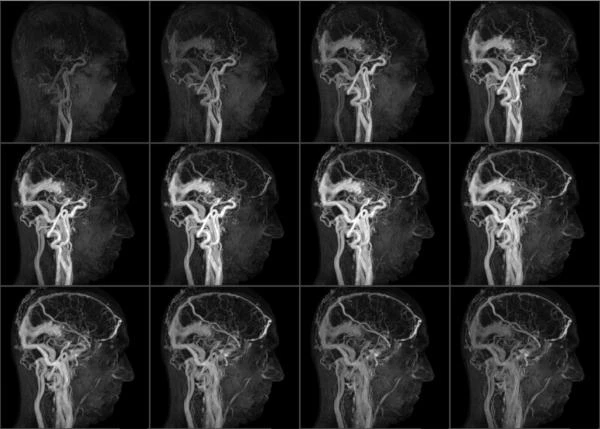 Фото МР-артериография головного мозга