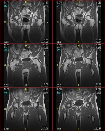 Фото МРТ тазобедренных суставов