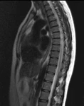 фото МРТ грудного отдела позвоночника