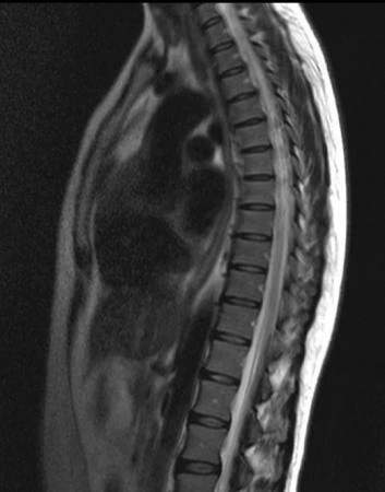 Фото МРТ грудного отдела позвоночника