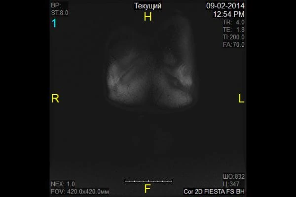 Фото МРТ брюшной полости