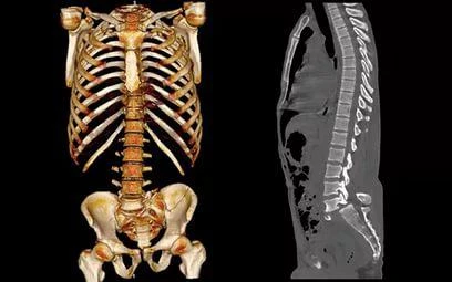 Фото КТ пояснично-крестцового отдела позвоночника