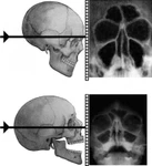 фото Рентгенография околоносовых пазух (2 проекции)