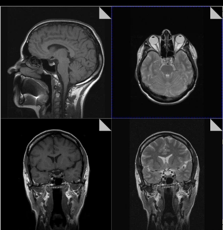 Фото МРТ головного мозга